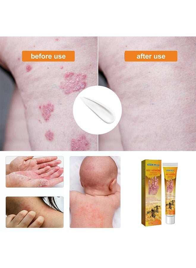 South Moon - Bee Venom Psoriasis Care Cream