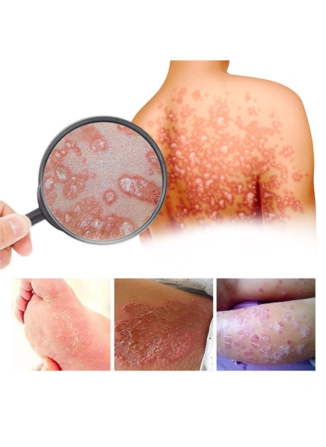 South Moon - Bee Venom Psoriasis Care Cream